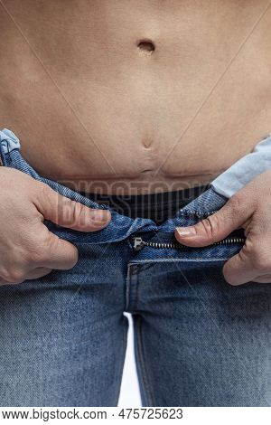 A Woman In Jeans Shows A Scar On Her Stomach. Consequences Of Caesarean Section And Operation On Umb