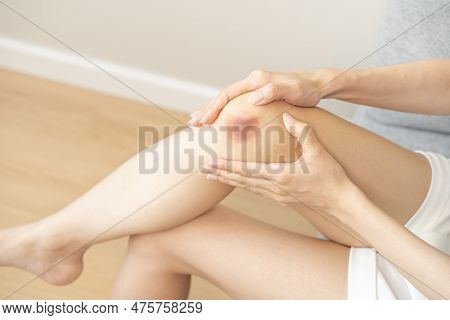 Close Up Of Stain Bruise Wound On Leg, Contusion Asian Young Woman, Girl On Joint Knee From An Accid
