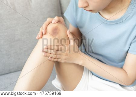 Close Up Of Stain Bruise Wound On Leg, Contusion Asian Young Woman, Girl On Joint Knee From An Accid