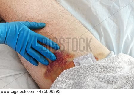 Hematoma On A Mens Leg Close-up. Huge Bruise On The Leg Of A Man After Endovascular Repair Due To Ta