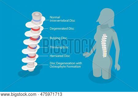 3d Isometric Flat Vector Conceptual Illustration Of Degenerative Disc Disease, Educational Medical S