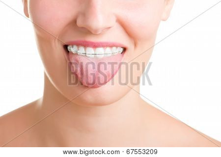 Braces
