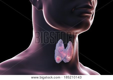 Thyroid cancer. 3D illustration showing thyroid gland with tumor inside human body isolated on black background