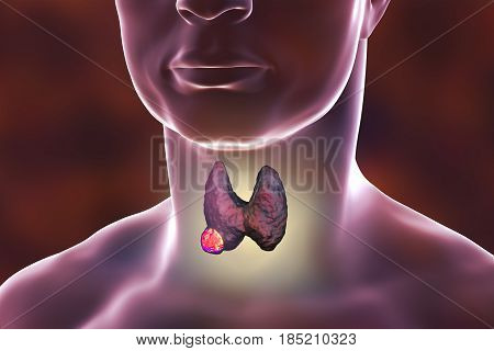 Thyroid cancer. 3D illustration showing thyroid gland with tumor inside human body
