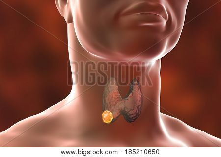 Thyroid cancer. 3D illustration showing thyroid gland with tumor inside human body