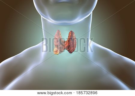 Thyroid cancer. 3D illustration showing thyroid gland with tumor inside human body
