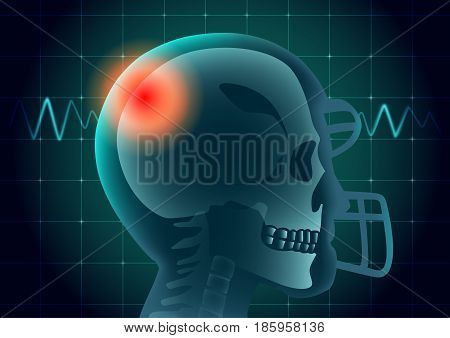 Skull of American football athlete have a red signal on physical monitor background. Illustration about medical diagnosis.