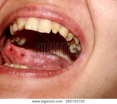 Amphotoid Stomatitis. Candidiasis Of The Tongue. Ulcer On The Tongue. Candida Fungus.