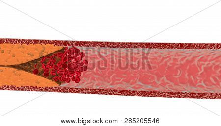 Blocked Blood Vessel. Artery With Cholesterol. 3d Render