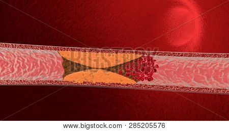 Blocked Blood Vessel. Artery With Cholesterol. 3d Render
