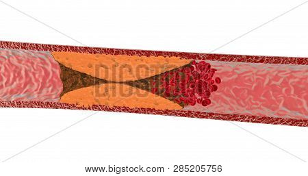 Blocked Blood Vessel. Artery With Cholesterol. 3d Render