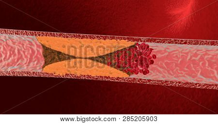 Blocked Blood Vessel. Artery With Cholesterol. 3d Render