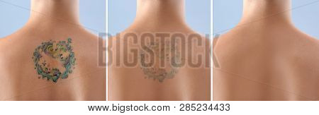 Young Woman Before And After Laser Tattoo Removal Procedure, Closeup