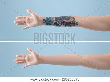 Young Woman Before And After Laser Tattoo Removal Procedure On Color Background, Closeup
