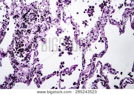 Histopathology Of Lung Emphysema, Light Micrograph, Photo Under Microscope Showing Enlargement Of Ai
