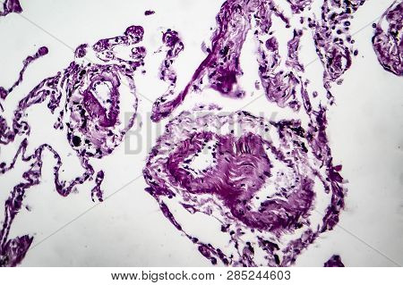 Histopathology Of Lung Emphysema, Light Micrograph, Photo Under Microscope Showing Enlargement Of Ai
