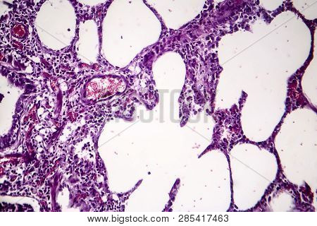Histopathology Of Pneumonia, Light Micrograph, Photo Under Microscope. Cellulose Aspiration Pneumoni