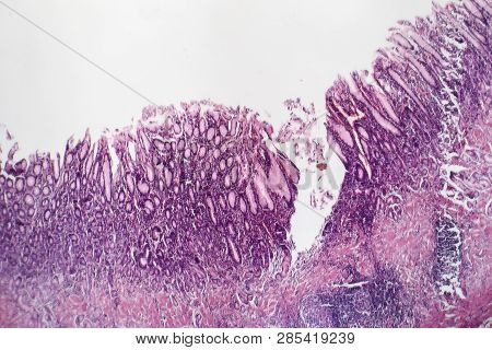 Histopathology Of Chronic Atrophic Gastritis, Light Micrograph, Photo Under Microscope
