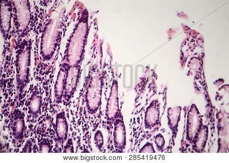 Histopathology Of Chronic Atrophic Gastritis, Light Micrograph, Photo Under Microscope