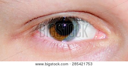 Multicoloured Eye. The Name Of This Mix On Eyes Is Heterokromi.