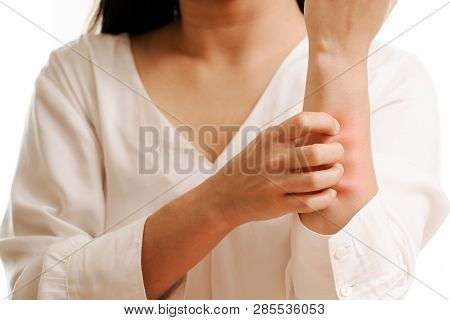 Women Hand Scratch The Itch On Arm, Healthcare And Medicine Concept