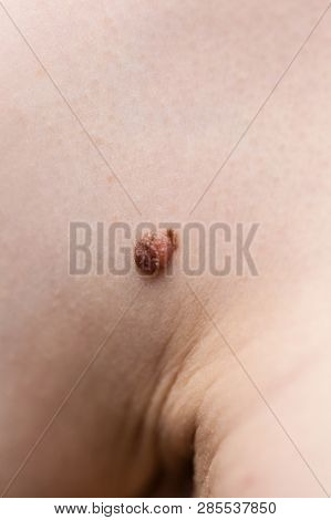 Unrecognizable Person Having Dark Fibroma, Dermatology Problem On Skin. Close Up Of Papilloma Dermat