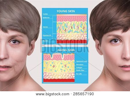 The Younger Skin And Aging Skin. Elastin And Collagen. A Diagram Of Young And Old Face Showing The D