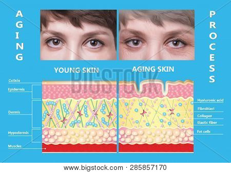 The Younger Skin And Aging Skin. Elastin And Collagen. A Diagram Of Young And Old Face Showing The D