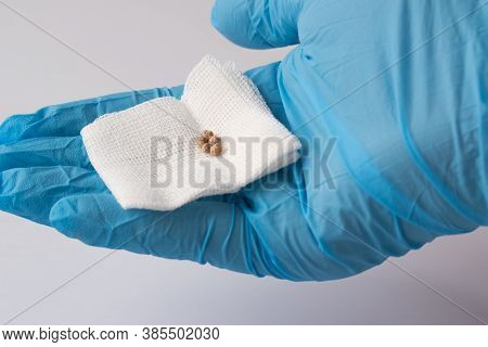 The Doctors Hand In A Blue Glove Holds The Cut Out Kami From The Gallbladder