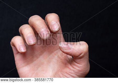 Close-up Of Female Caucasian Hand With Dirty Brittle Nails, Broken Nails On A Black Background. Peel