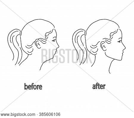 Silhouette Of A Female Head On A White Background. Facial Correction And Posture. Vector Illustratio