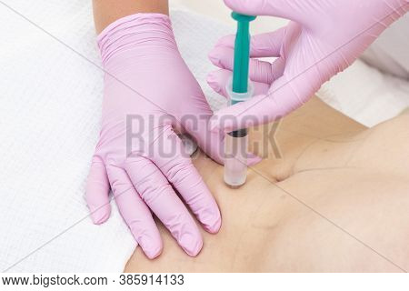Lipolytic Injections Are Placed In The Stomach. Female Hands In Pink Gloves Inject A Young Woman Int