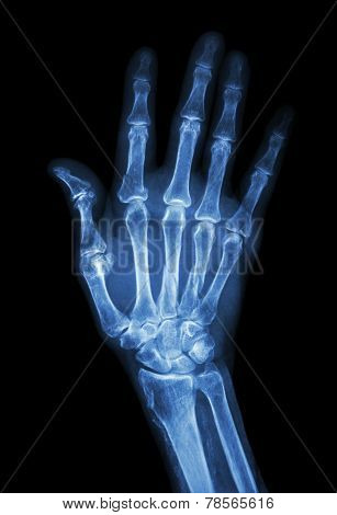 Multiple Fracture At Index,little Finger,metacarpal Bone