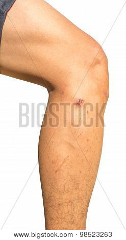 Scars On Leg Isolated On White Background With Clippingpath