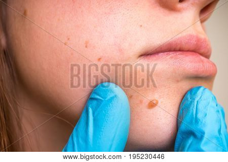 Woman with birthmark on her face skin tags removal - cosmetic surgery