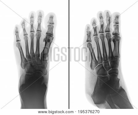 Film x-ray both normal human foots . 2 position ( front view and side view )