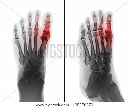 Gouty arthritis . film x-ray of human foot and arthritis at first metatarsophalangeal Joint . 2 position ( front and side view )