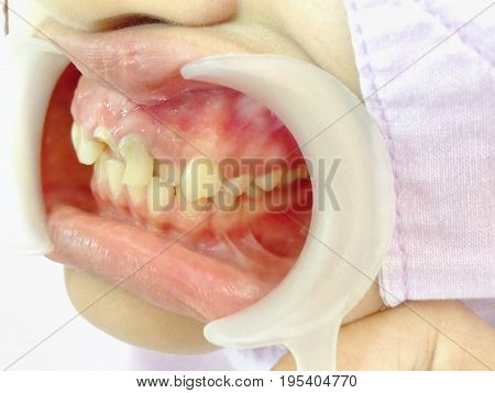 Front teeth broken by accident  checked up by the dentist