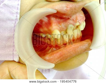 Front teeth broken by accident  checked up by the dentist