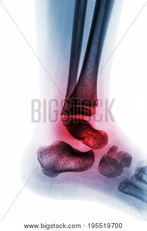 Arthritis of ankle . X-ray of child ankle and inflame joint . Lateral view . ( Concept of Juvenile rheumatoid )