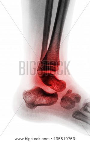 Arthritis of ankle . X-ray of child ankle and inflame joint . Lateral view . ( Concept of Juvenile rheumatoid )