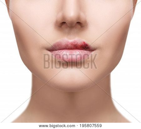Plump female lips with herpes sore isolated on white.