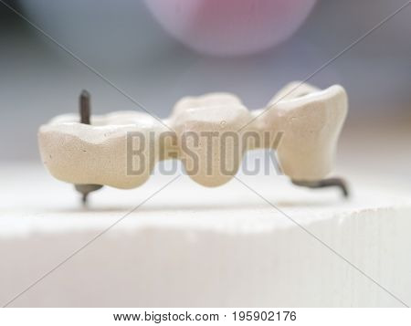Mplants Teeth Made In The Technic Opaque Porcelain Dental. Oxidized Metal Opaque.