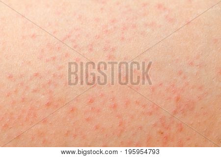 Close up picture of folliculitis problem on female skin