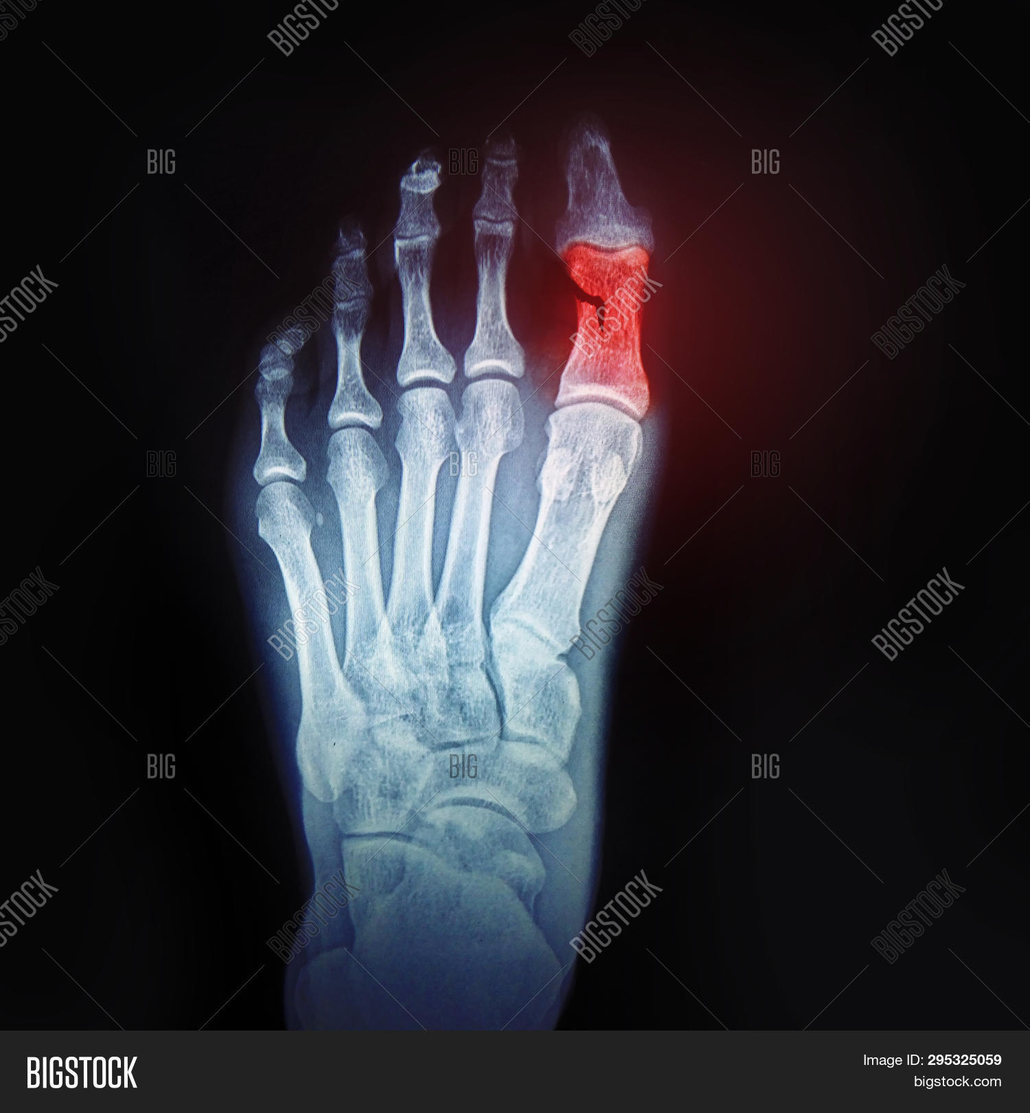 Broken Toe. Xray Foot Image & Photo (Free Trial) Bigstock