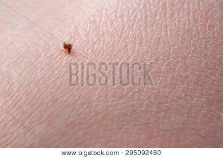 Sharp Bee Sting With A Bag Of Poison Broke The Skin And Left It. Apitherapy. Treatment With Bee Stin