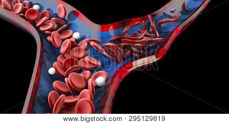 Sickle Cell Anemia, Showing Blood Vessel With Normal And Deformated Crescent. 3d Illustration