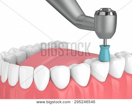 3D Render Of Jaw With Dental Handpiece And Polishing Prophy Cup