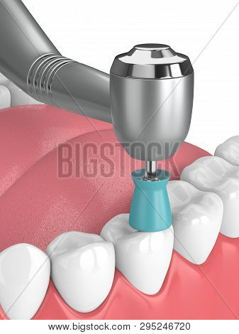 3D Render Of Jaw With Dental Handpiece And Polishing Prophy Cup