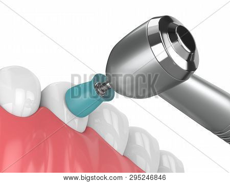 3D Render Of Jaw With Dental Handpiece And Polishing Prophy Cup